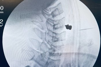 Казанские врачи извлекли пулю из шеи пациента