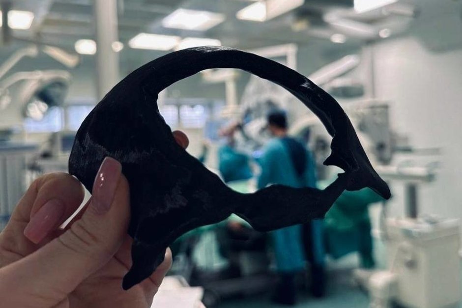 Врачи РКБ Татарстана восстановили бойцу СВО лоб с помощью 3D-принтера