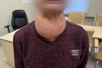 В РКБ Татарстана удалили щитовидку размером с голову