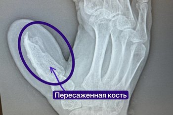 Татарстанские медики провели уникальную пересадку пальца