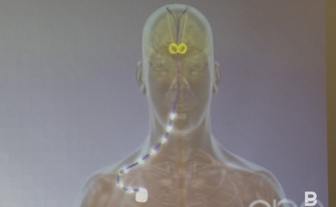 Казанские ученые рассказали о влиянии анестетиков на головной мозг