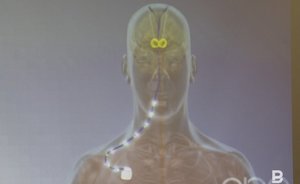 Казанские ученые рассказали о влиянии анестетиков на головной мозг